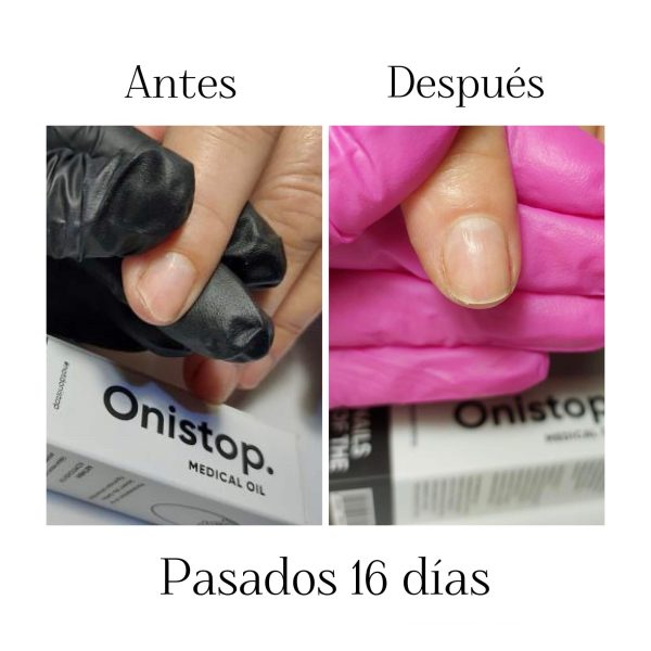 antes y despues onistop